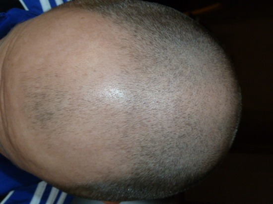 hajátültetés fue hairhungary safesystem-fue2