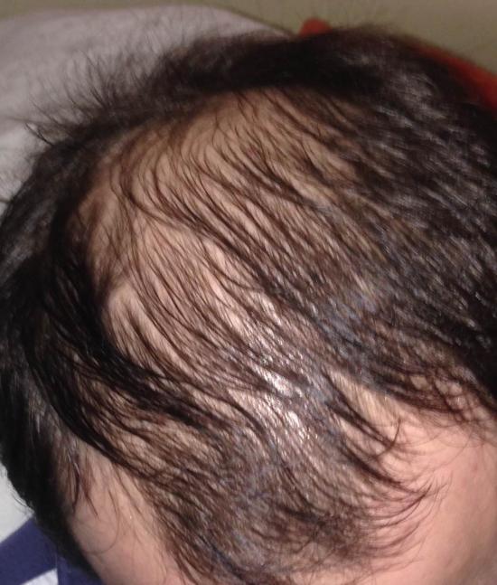 hajbeültetés kopaszodás hairhungary klinika hajbeültetés előtt