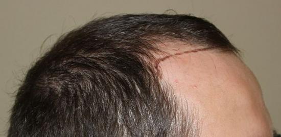 hajbeültetés kopaszodás hairhungary klinika hajbeültetés előtt