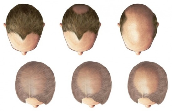 genostella hairgs1 genetikai teszt kopaszodás teszt hajhullás teszt Szegedi Tudományegyetem bőrgyógyászat androgén hajhullás androgén alopécia hairhungary hajklinika