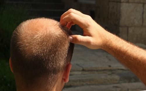 hajhullás kopaszodás hajritkulás hajátültetés hairhungary anyajegy hajas fejbőr anyajegy a fejbőrön