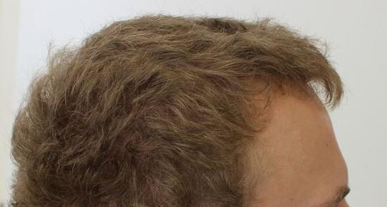 hajhullás kopaszodás hajátültetés hajbeültetés hairhungary páciensek rokkerzsoltti hajbeültetés blog