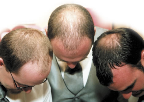 hajhullás kopaszodás hajritkulás öröklött kopaszodás öröklés genetika hairhungary hajátültetés hajbeültetés hajbeültetés blog