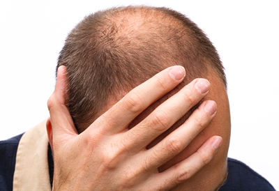 hajhullás kopaszodás kopasz foltok hairhungary hajátültetés hajbeültetés hajbeültetés blog hajszálak kedvezmény novemberi kedvezmény egészséghitel részletfizetés