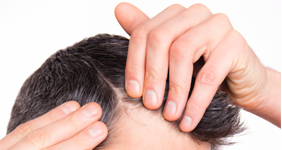 hajhullás kopaszodás öröklött kopaszodás hajátültetés hajbeültetés hajbeültetés blog hairhungary öregedés őszülés hajgyérülés kopasz foltok homlokvonal kedvezmény