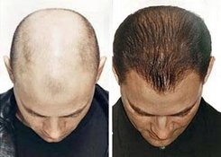 kopaszodás hajhullás hairhungary hajbeültetés hajátültetés fiatalodás