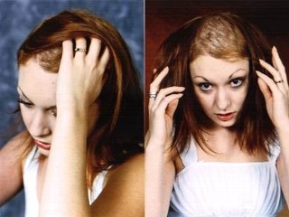 hajtépés hajtépkedés betegség kényszerbetegség viselkedéskényszer hajátültetés hajbeültetés hairhungary