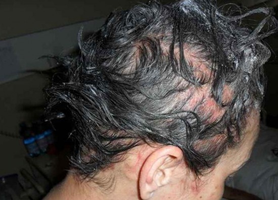 hajfesték hajfestés hajhullás kopaszodás hairhungary hajbeültetés hajátültetés