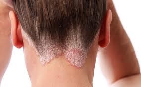 pikkelysömör hajhullás hairhungary betegség hajátültetés kezelés